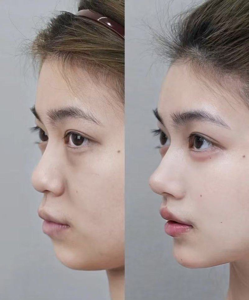 二、假体隆胸后几天可以下床?