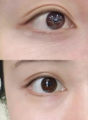 三、常见部位抽脂:修复期细节与快速修复技巧