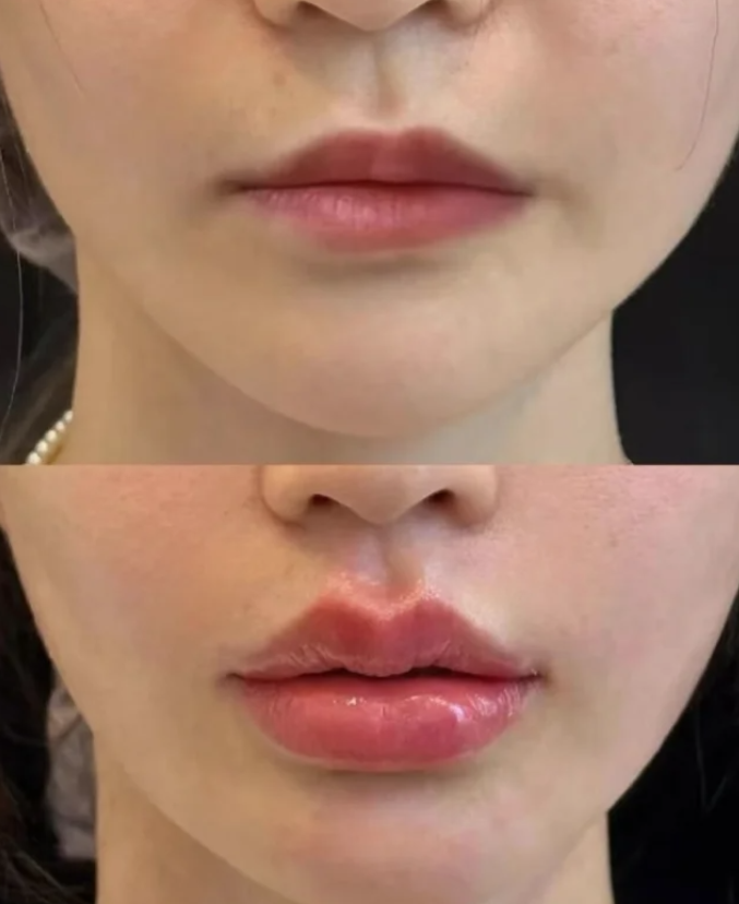 二、术后长期/自然老化导致内双:定制化修复方案是关键