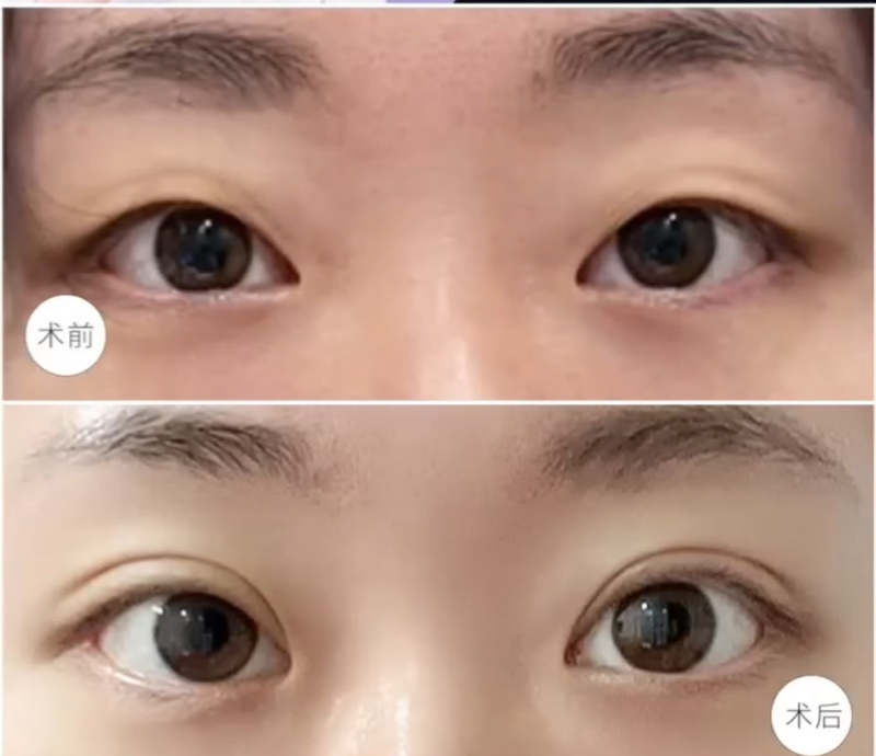 五、忆辰莱去眼袋原理存疑,无科学依据