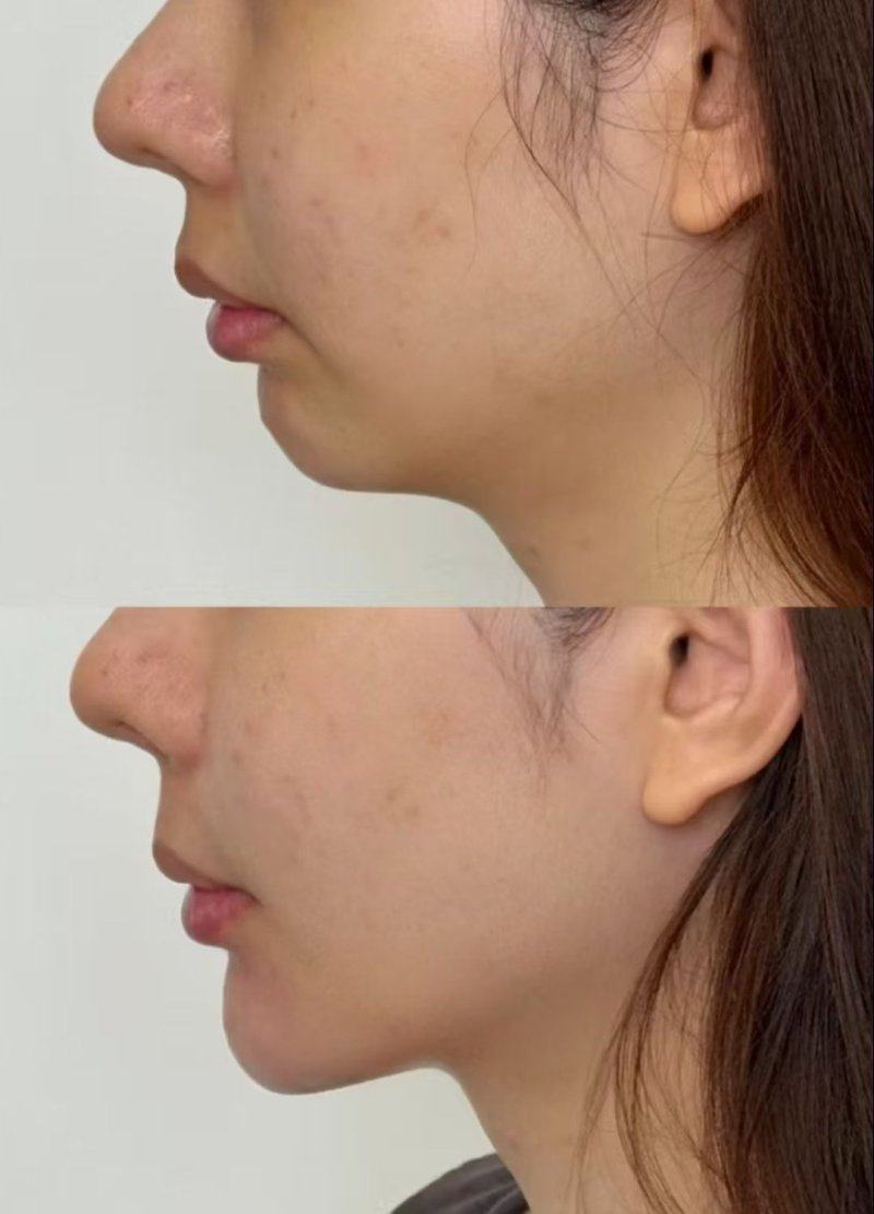 四、内切眼袋术后细纹的特殊修复方法