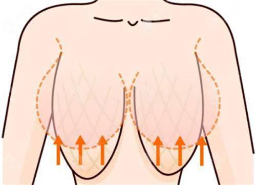 二、增生性疤痕疙瘩:多维度疗法抑制增生防复发