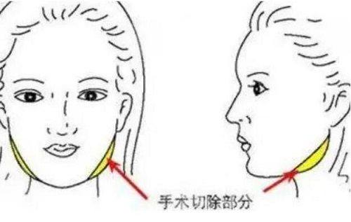 二、暂时型/轻度眼袋:日常护理就能有效改善