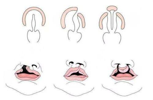 四、瘦脸针是不是会让脸部越来越松