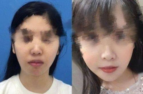 鼻子上疤痕能修复到以前吗?修复成效看得见