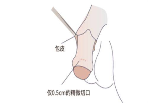 五、影响腹部吸脂成效的关键因素
