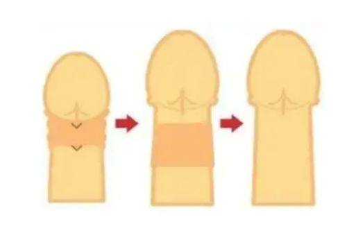 三、真性眼袋:医美手术精细解决