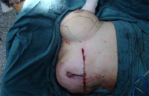 二、2025年专精热敷去眼袋方案：盐水热敷法