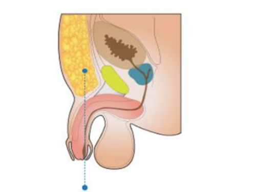三、日常简易热敷法：应急舒缓水肿型眼袋