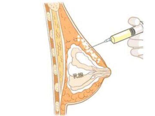 眼睛热敷可以去眼袋吗？分3类眼袋看成效，附实测有效的正确热敷方案