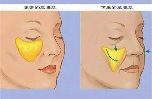 二、常见的脸部抽脂手术方式