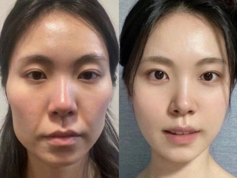 五、双眼皮拆线的注意事项有哪些