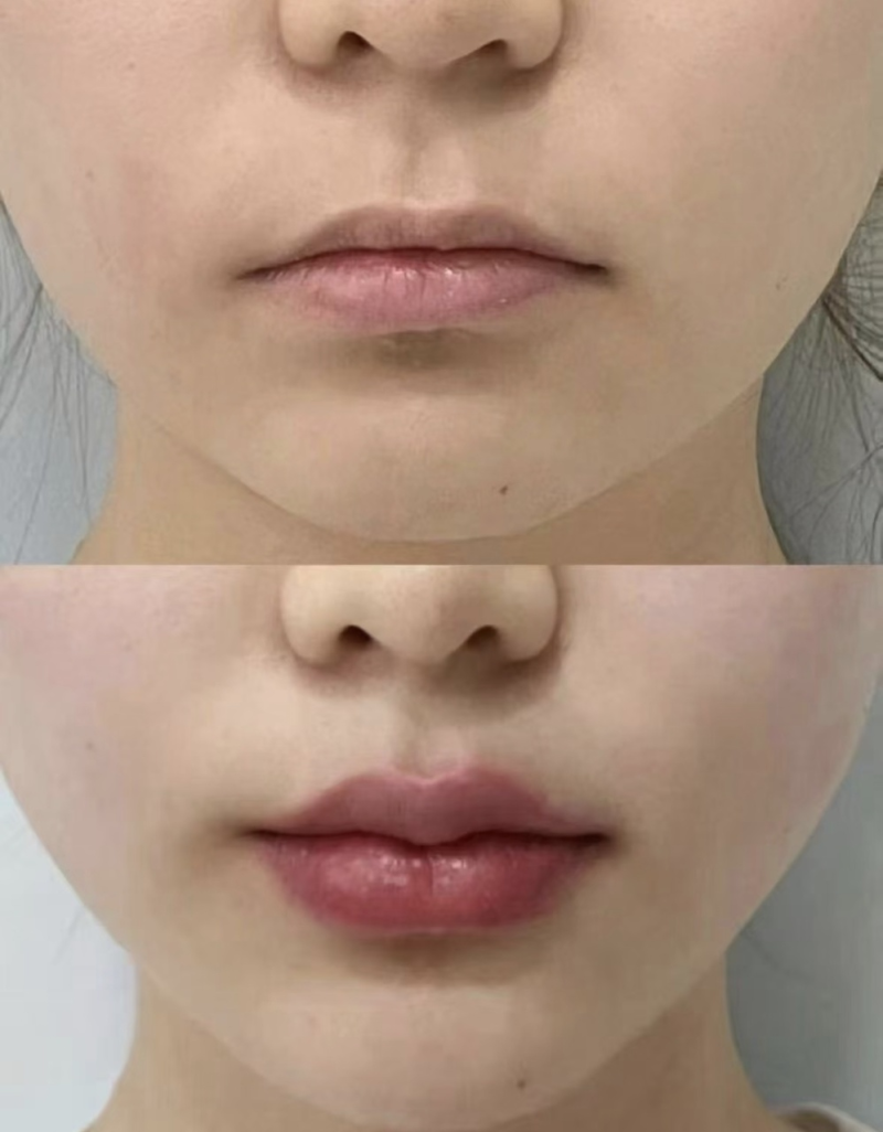 割双眼皮为什么要拆线？不用吸收线？全切也得拆，防疤避开裂保术后效果