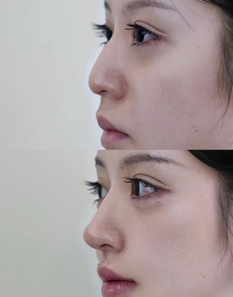 三、白毒瘦脸针对女性身体有危害吗