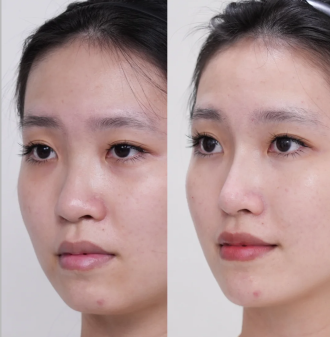 三、双眼皮全切为什么必须拆线