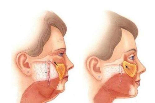 三、假体隆胸不够软怎么办