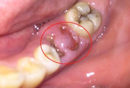 五、按摩消眼袋的关键注意事项