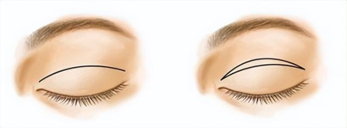 五、割双眼皮避坑指南:不花冤枉钱