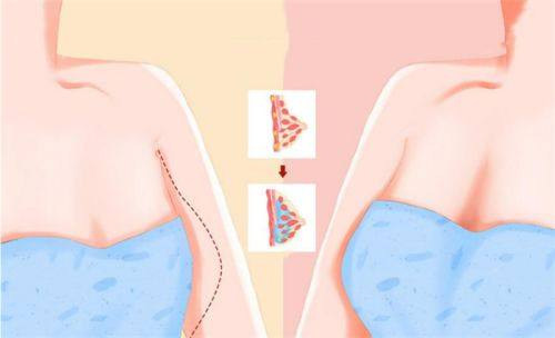 五、假体隆胸多久能变软