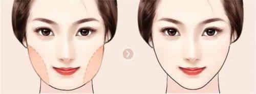 三、适合一单一双的3种双眼皮手术术式