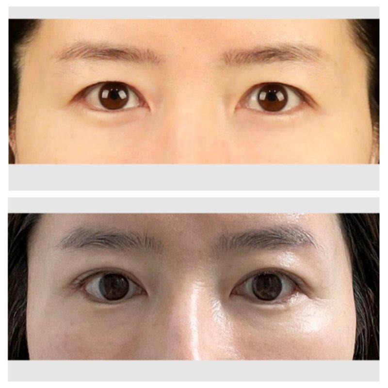 四、搭配这些物质，按摩消眼袋成效翻倍