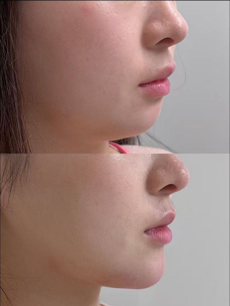 油烫伤疤痕用什么药膏好:2026年热门口碑款盘点