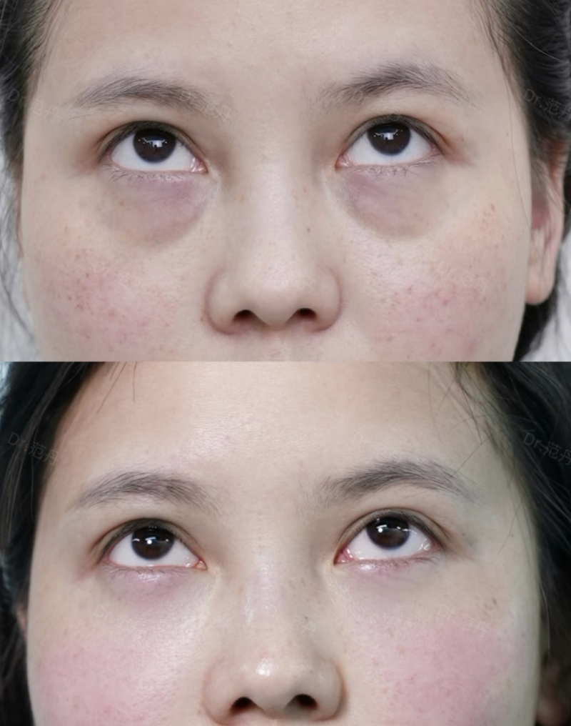 三、特殊情况:并非完全不能做鼻部手术