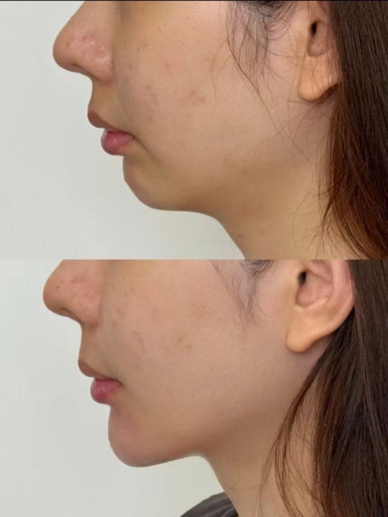 五、有双眼皮做术前,这些细节不能忽略