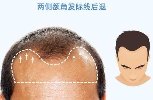 不同类型烫伤疤痕的针对性修复方案