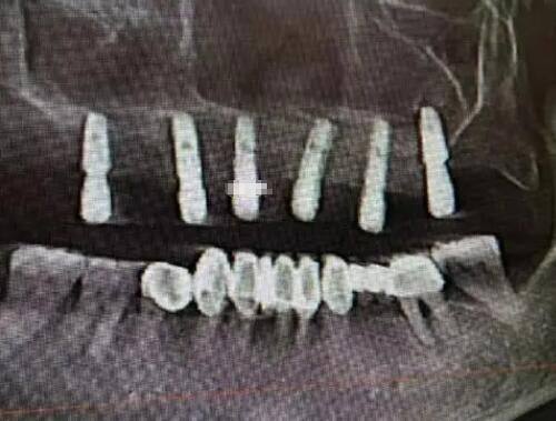四、饮食管理：从根源避免剩余脂肪细胞膨胀