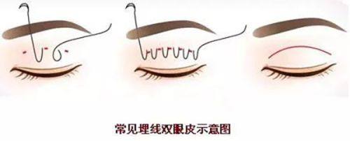 二、日常护理细节：从习惯上加速消肿