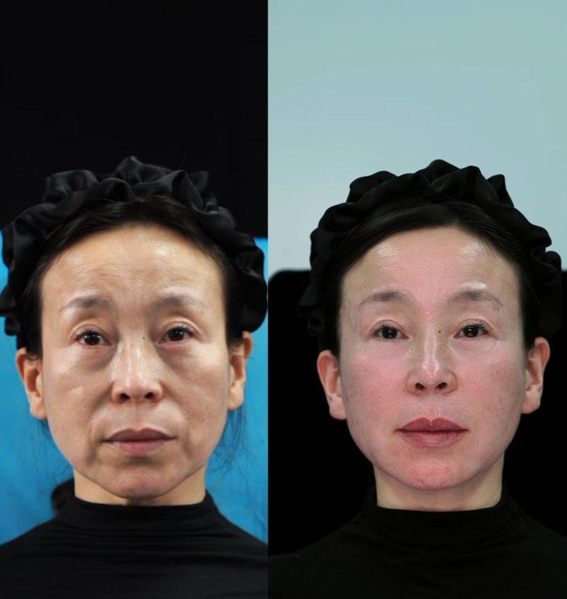 五、注射完瘦脸针的长期护理与避坑提醒