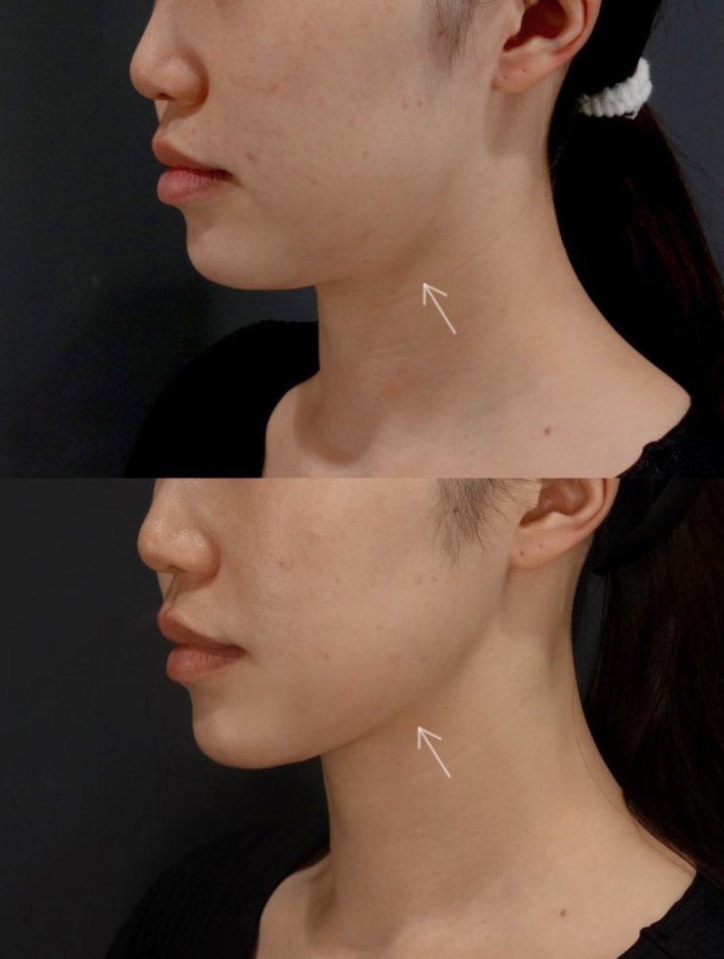 三、面部凹陷：长期打瘦脸针的不可逆面部损伤