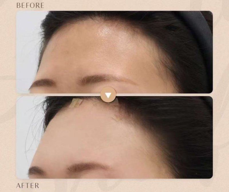 二、影响抽脂成效维持时长的关键因素