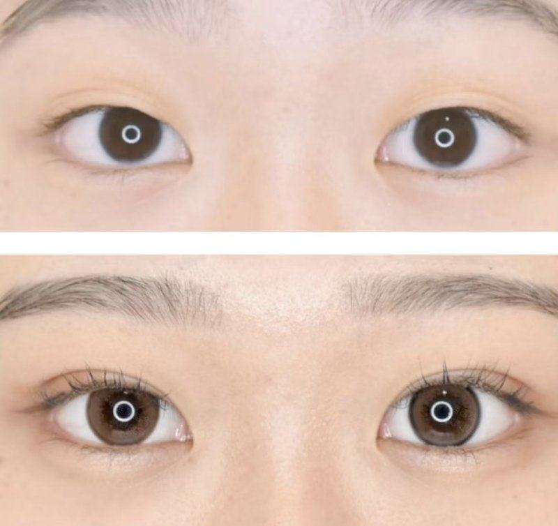 二、脸部僵硬：长期打瘦脸针更直观的面部副作用