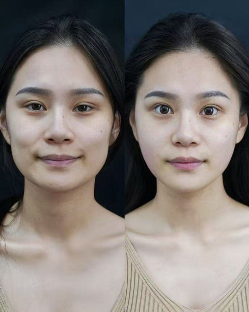 四、鼻梁上的疤痕可以手术切除吗?