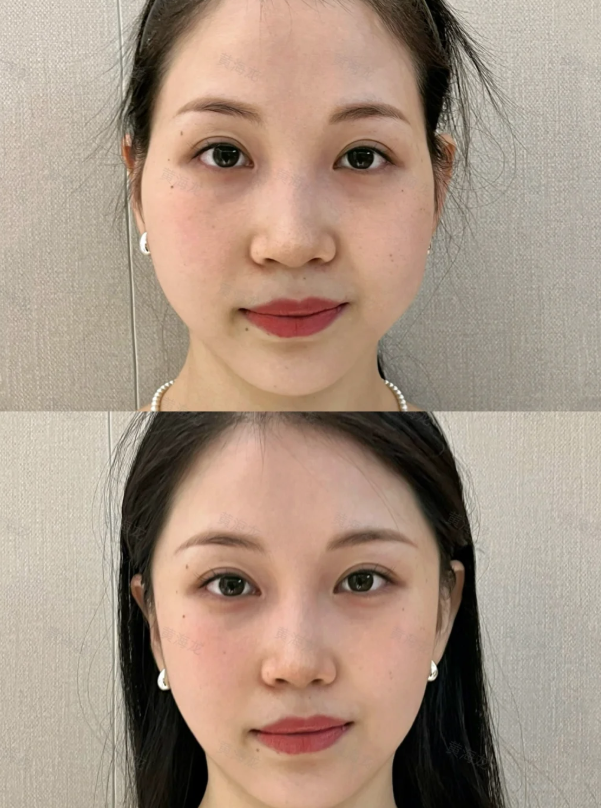 三、眼部基础变化:偶尔“睡变单”?临时修复与长期改善方案