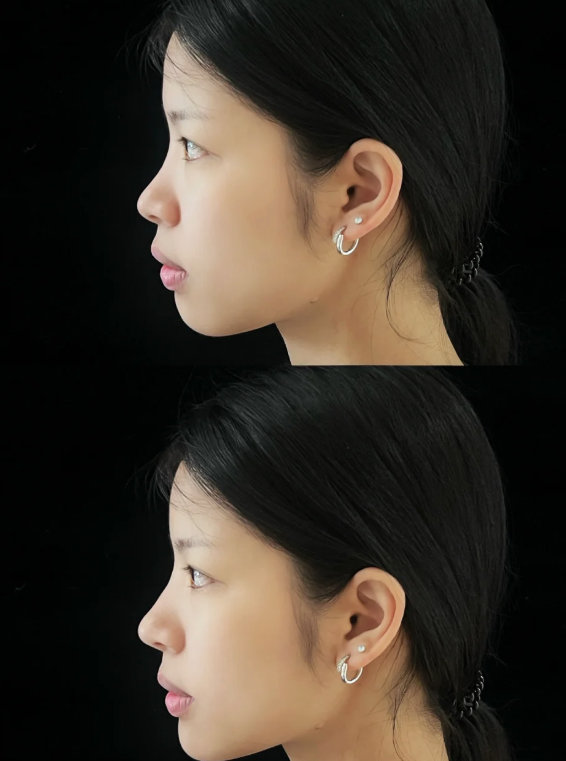 三、眼部术后白色疤痕的针对性处理