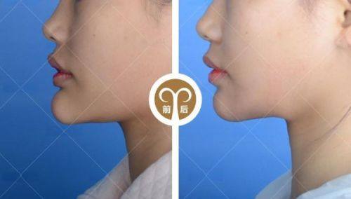 四、注射风险与安心把控:这些细节不能漏