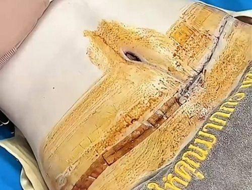 哪种祛眼袋效果好？7类方法+各地靠谱机构+真实案例帮你精准匹配方案