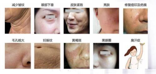 二、手术联合激光:顽固性大面积疤痕的“黄金方案”