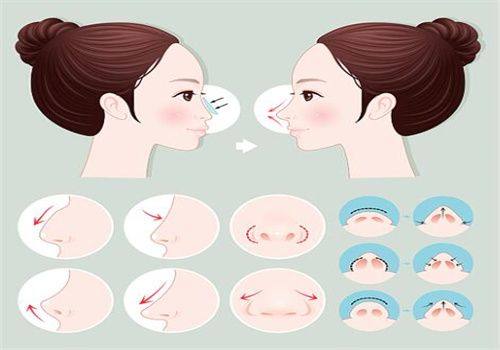 三、瘦脸针的适用边界:不是所有脸宽都能救