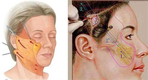 二、眼袋脂肪填充的成活率:70%-85%是行业主流水平