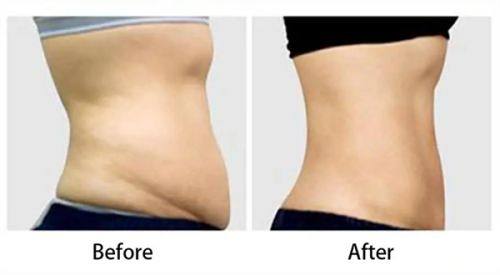 二、自体毛发移植的操作原理：从提取到种植的完整路径