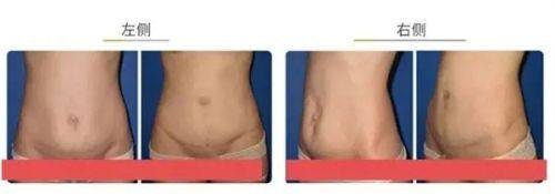 四、激光治疗细分:不同疤痕适配不同技术