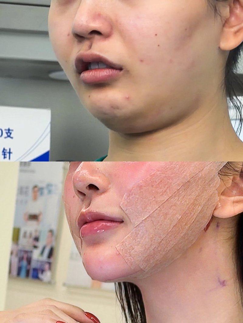 三、各地靠谱祛眼袋机构的技术优势与真实实例