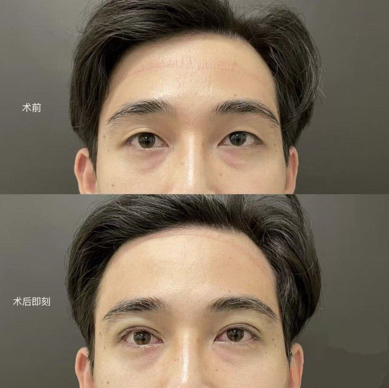 二、缝合阶段:从源头降低缝针疤痕形成概率