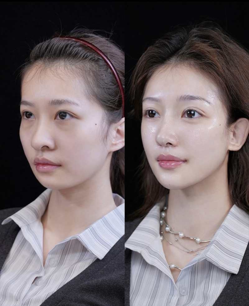 二、纳米技术双眼皮的常见术式及操作方式