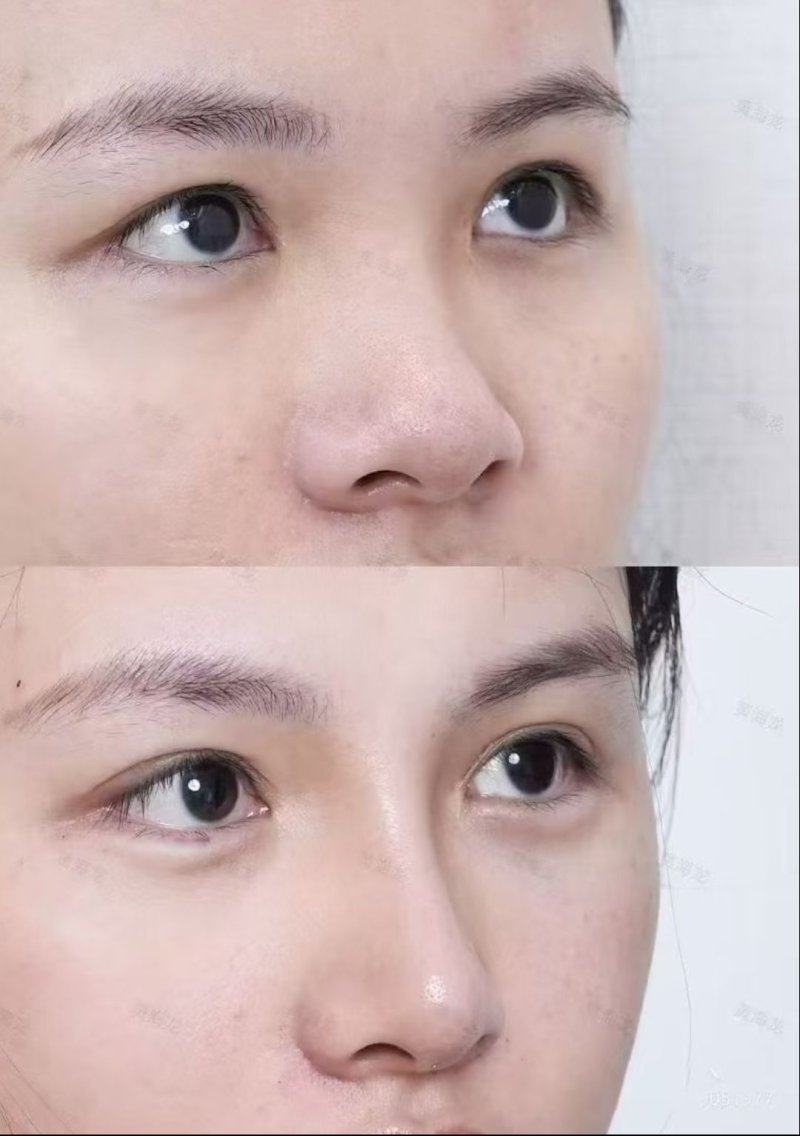 五、药物与注射:轻中度疤痕的便捷选择