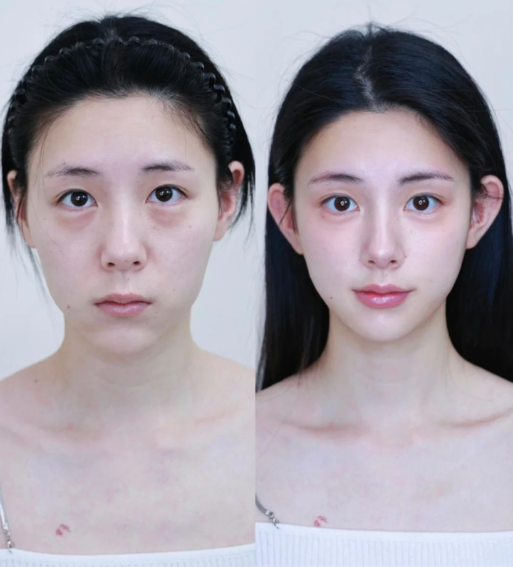 五、祛眼袋术后护理要点，保护成效不反弹